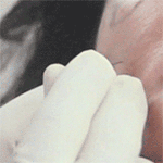 DermaSculpt Microcannula puncture hole
